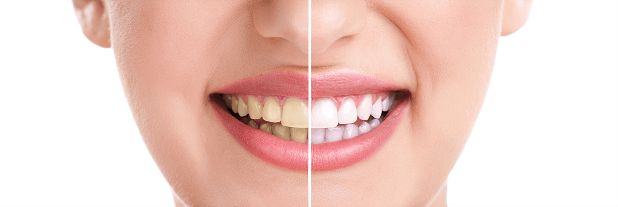 Teeth Whitening in Frederick MD